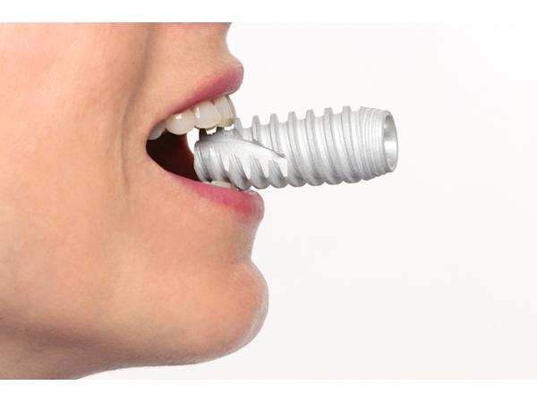 Bild 12 von Jahl Gerald DDr.- Implantat im Zentrum