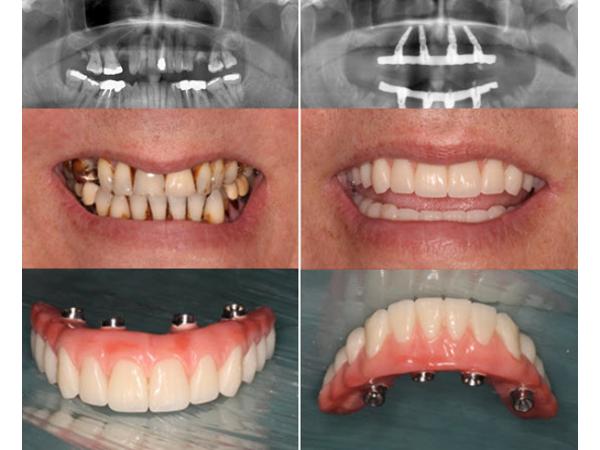 Bild 11 von Jahl Gerald DDr.- Implantat im Zentrum
