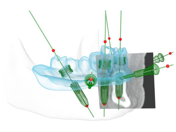Bild 9 von Jahl Gerald DDr.- Implantat im Zentrum