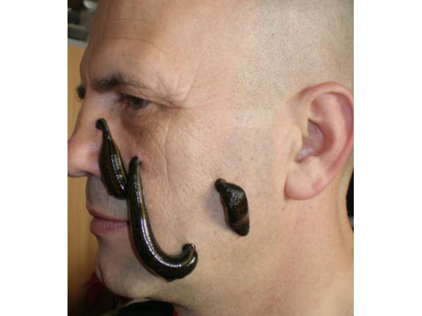 Bild 4 von Peter Grasser, Blutegeltherapie, Schmerztherapie