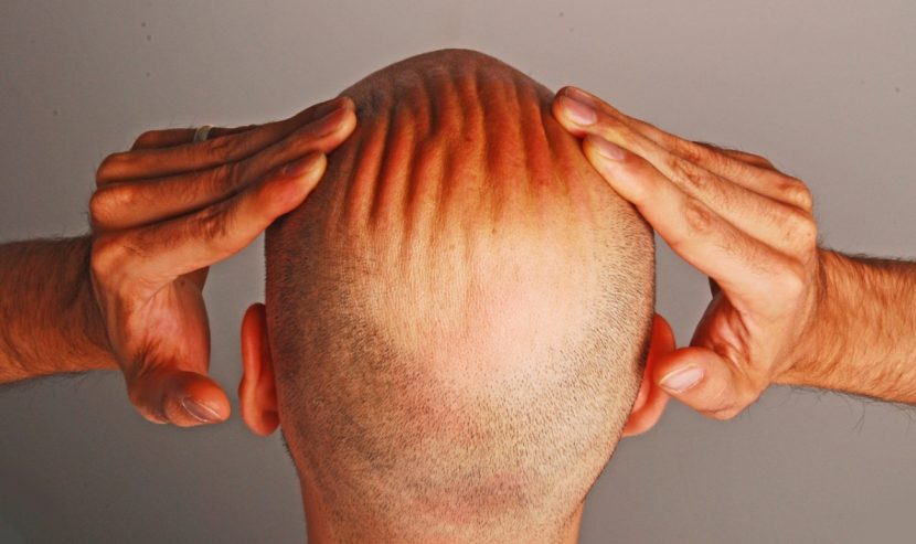Haartransplantation Wien, Methode, Haare