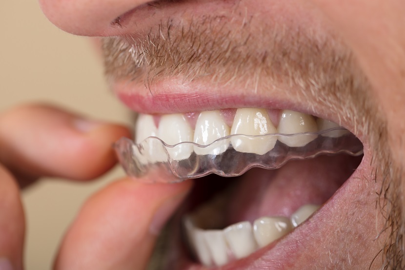 zahnspange Brackets