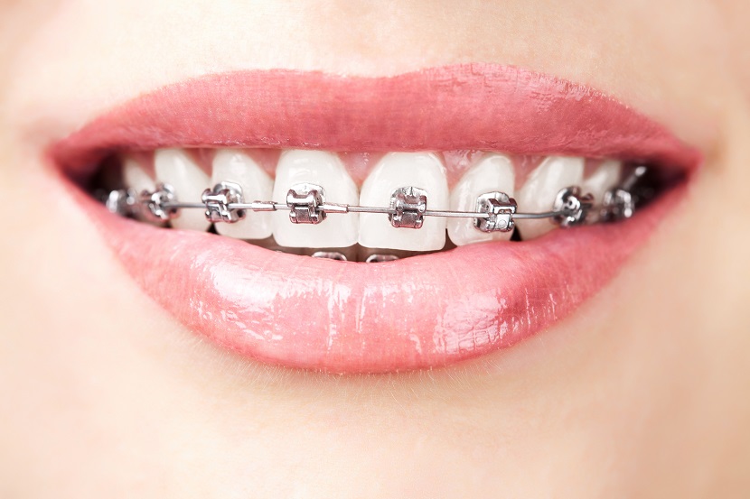 Zahnspange Brackets