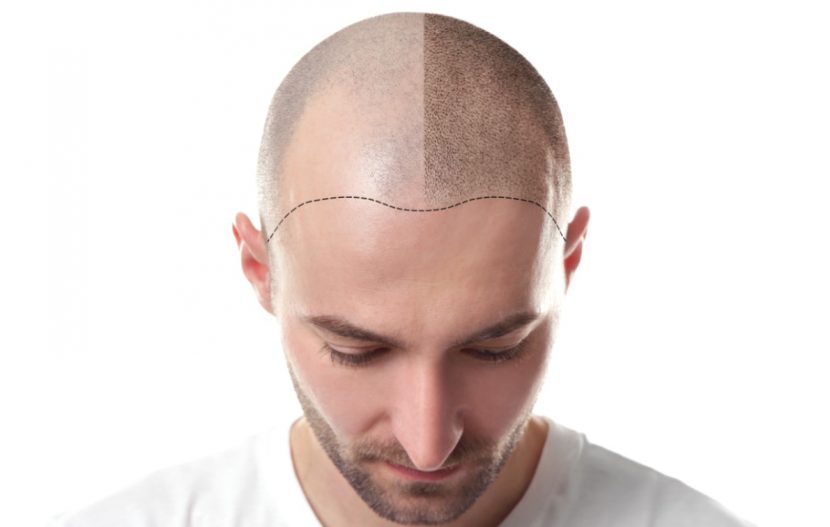 Haartransplantation