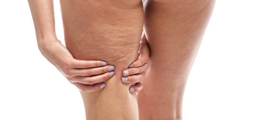 Cellulite loswerden am Oberschenkel: Wie kann ich Orangenhaut bekämpfen?