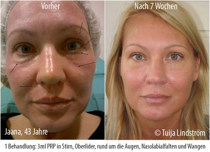 Vampir Lifting! Gesichtsverjüngung ohne OP HEROLD.at