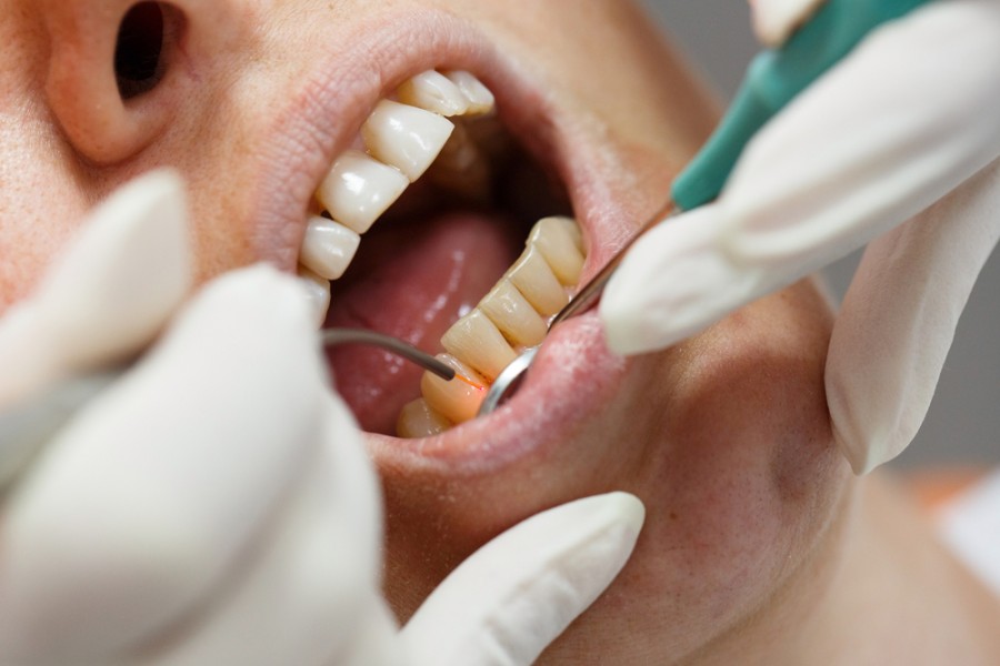 Zahnarzt-Laser