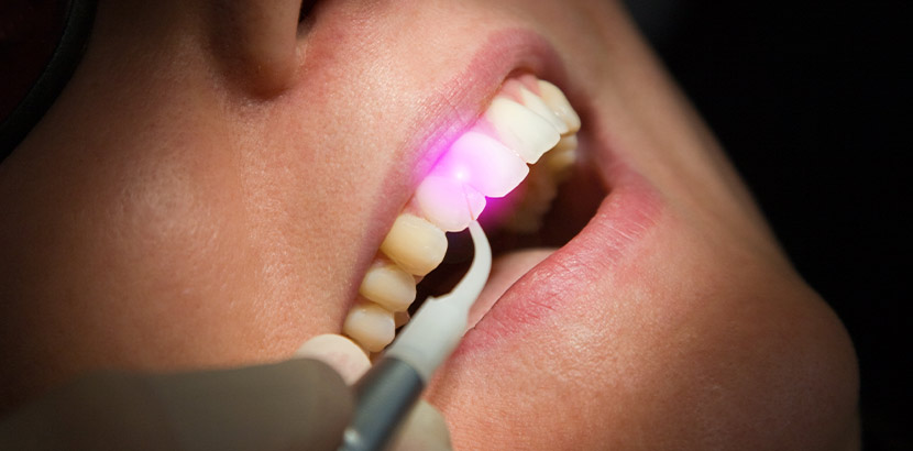 Zahnarzt Laser: Eine Laserbehandlung am Zahn bei einem Patienten