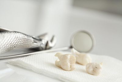 Ein Tablett, auf dem nach einem Eingriff in Vollnarkose mehrere Zähne liegen. Weisheitszähne ziehen.