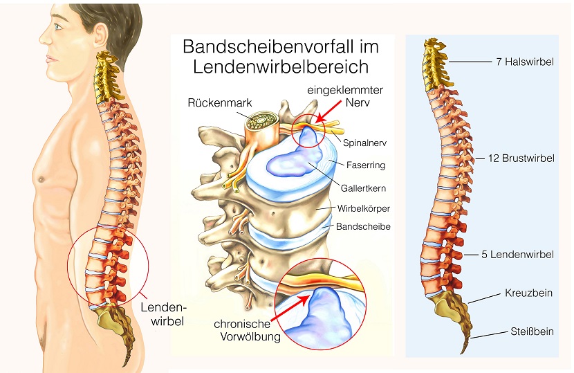 bandscheibenvorfall behandlung