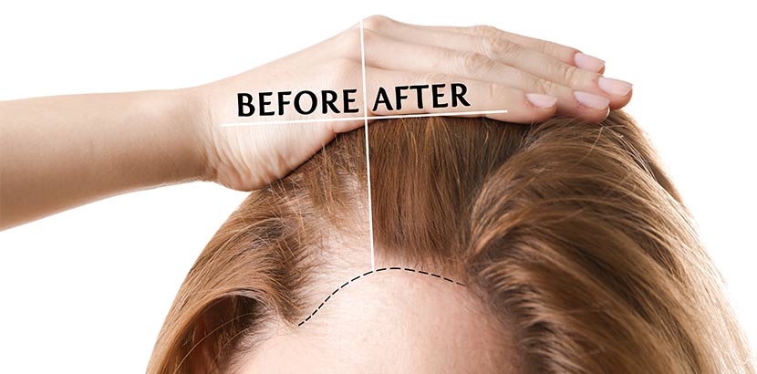 Haarausfall Stoppen Das Hilft Gegen Haarverlust Bei Frauen Herold At