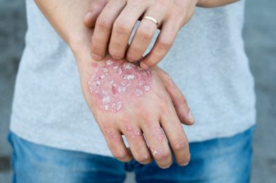 Psoriasis oder Schuppenflechte an der Hand