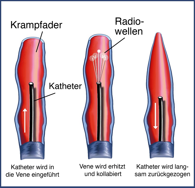 Besenreiser
