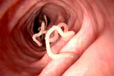 Aufnahme eines Bandwurms in einem menschlichen Darm.