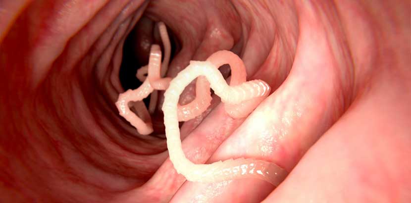 Aufnahme eines Bandwurms in einem menschlichen Darm.