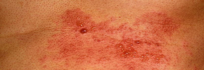 Gürtelrose durch den Virus Herpes Zoster verursacht auf einem männlichen Oberkörper.