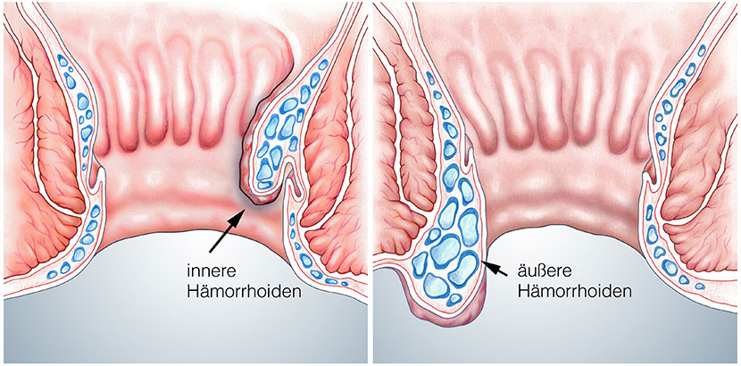 Grafik von vergrößerten Hämorrhoiden im Darm (links) und außerhalb des Darms (rechts). Hämorrhoiden Behandlung Wien.