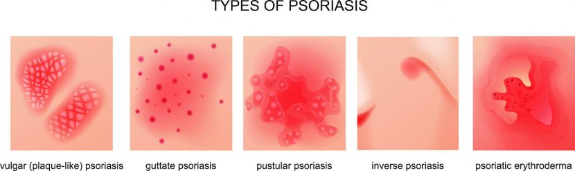 Psoriasis Formen von Schuppenflechte