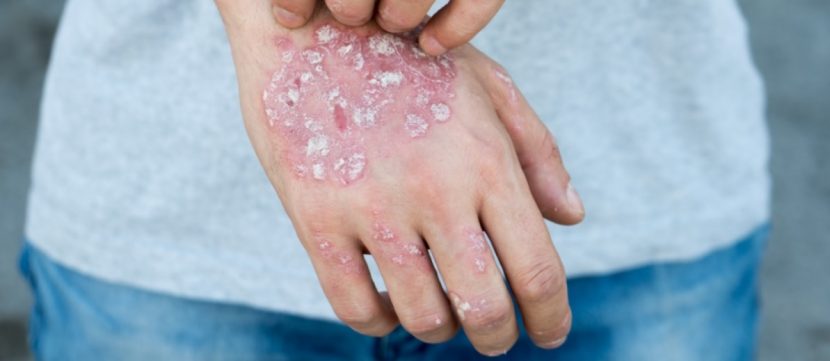 Psoriasis oder Schuppenflechte an der Hand