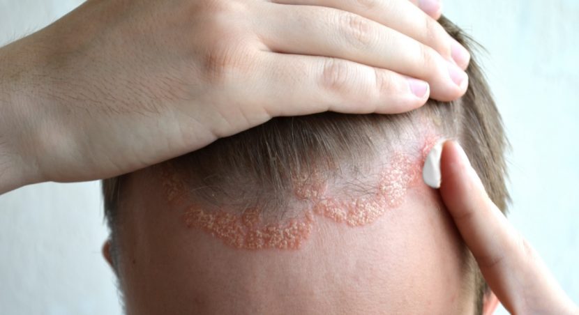 Psoriasis, Schuppenflechte auf der Kopfhaut