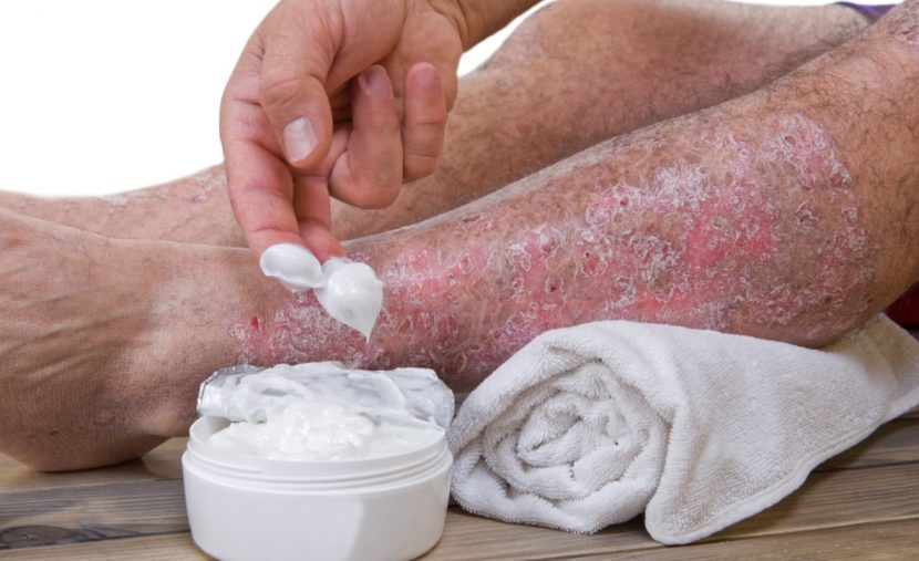 Psoriasis Schuppenflechte Therapie