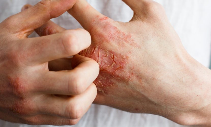 Psoriasis Juckreiz Schuppenflechte