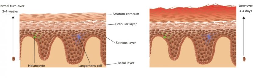 Psoriasis, Schuppenflechte Symptome