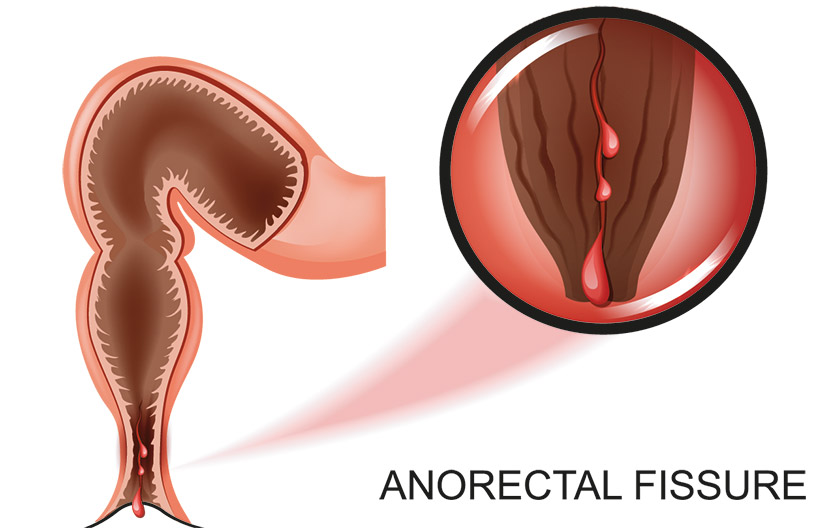 Analfissur