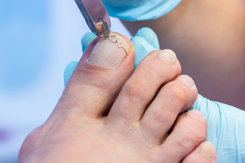 Ein Fußpfleger setzt eine Nagelkorrekturspange auf einen Zehennagel.