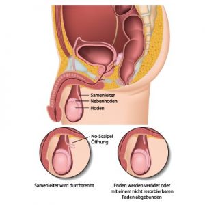 Vasektomie Wien