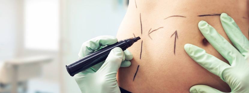 Chirurg zeichnet Schnittrichtung für Bauchdeckenstraffung auf dem Bauch einer jungen Frau vor.
