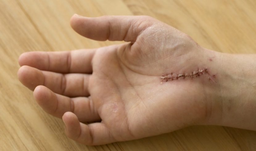 Rechte Hand mit Operationsnarbe von einem operierten Karpaltunnelsyndrom.