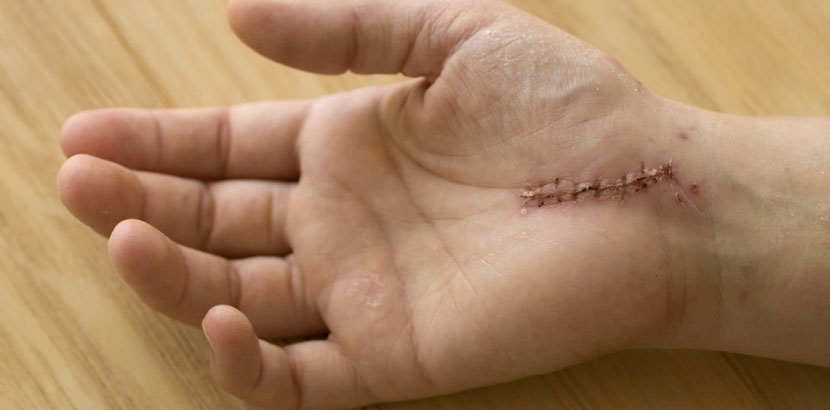 Hand mit einer Narbe von einer Karpaltunnelsyndrom Operation.