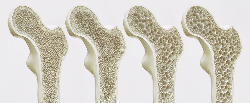 die vier Stadien der Osteoporose