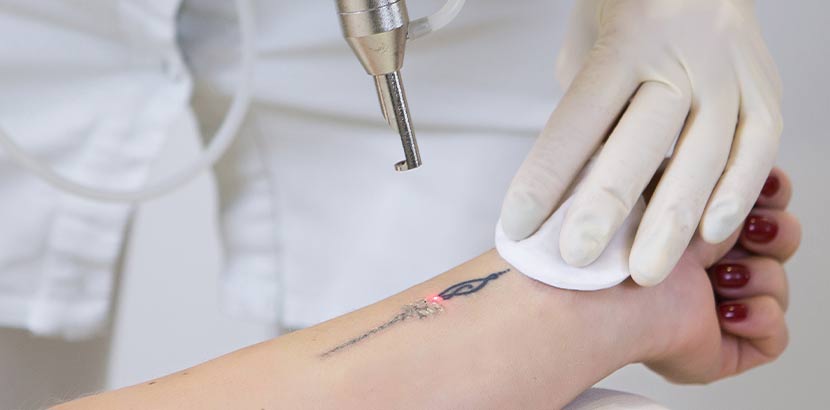 Nahaufnahme eines Lasers, der eingesetzt wird, um das Tattoo auf dem Arm einer jungen Frau zu entfernen. Hautarzt Wien.