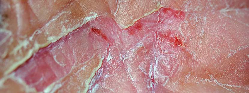 Von Neurodermitis betroffene Handfläche eines Erwachsenen.