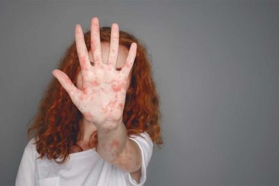 Junge Frau, die ihre von Neurodermitis gerötete Hand in die Kamera hält. Neurodermitis Erwachsene.