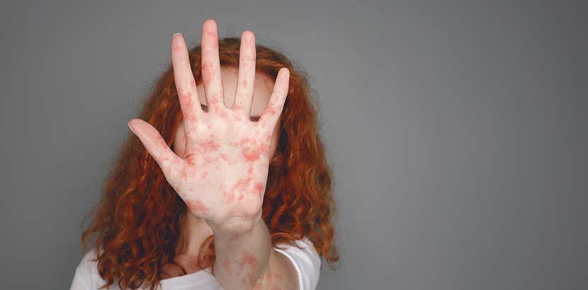 Junge Frau, die ihre von Neurodermitis gerötete Hand in die Kamera hält. Neurodermitis Erwachsene.