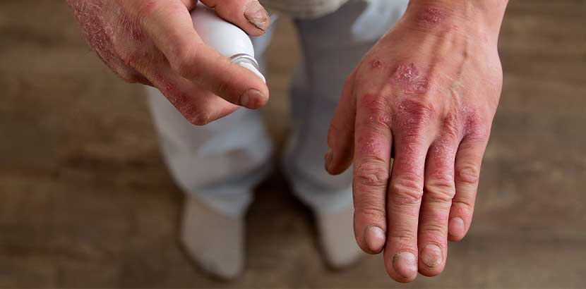 Mann mit Neurodermitis an den Händen, der eine Feuchtigkeitscreme zur Linderung verwendet. Neurodermitis Erwachsene.
