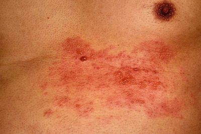 Gürtelrose durch den Virus Herpes Zoster verursacht auf einem männlichen Oberkörper.