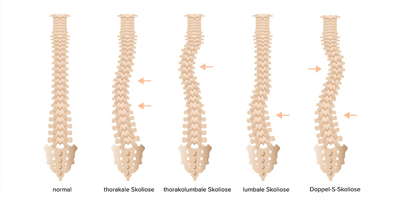Skoliose