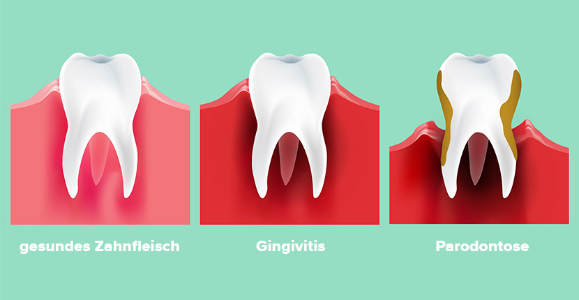 Zahnfleischentzündung