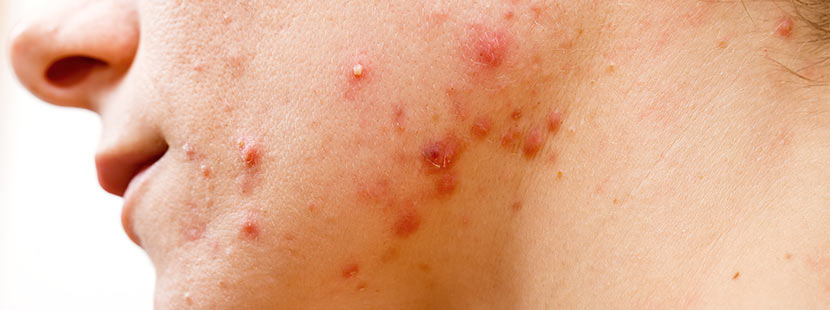 Abszess | Behandlung mit Salben & Hausmittel - HEROLD