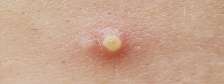 Abszess | Behandlung mit Salben & Hausmittel - HEROLD