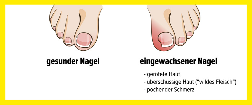 Eingewachsener Zehennagel Fotos: links ein gesunder Nagel, rechts ein eingewachsener Nagel