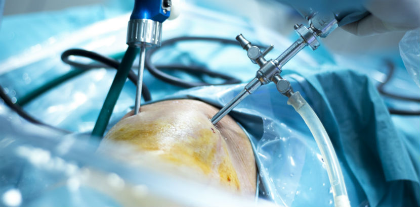 Meniskus-Operation mittels Kniegelenksarthroskopie. 