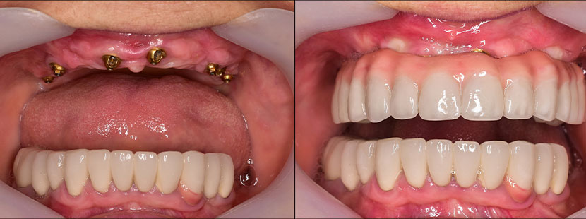 Vorher-Nachher-Bild einer Zahnimplantation im Oberkiefer. Zahnimplantat Wien Kosten.