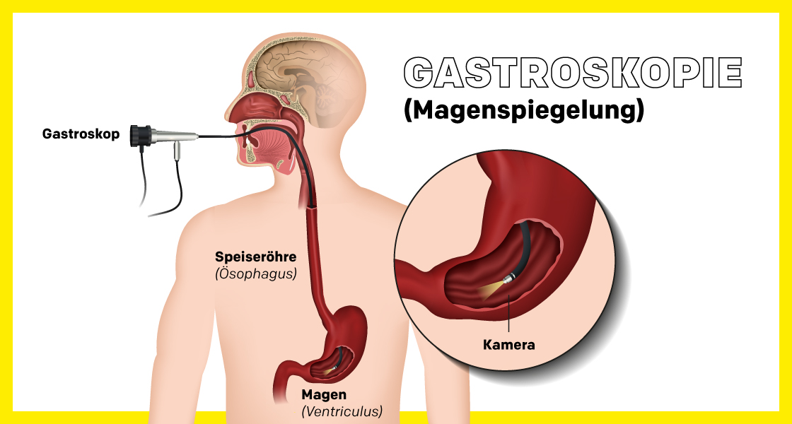 Magenspiegelung Infografik