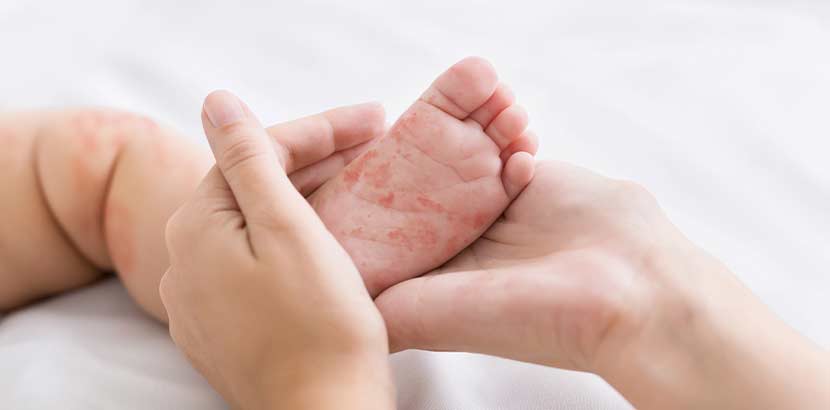 Pflege von Neurodermitis und trockene Haut