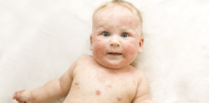 Neurodermitis bei einem sitzenden Kleinkind. Tipps und Informationen zur Hautpflege.